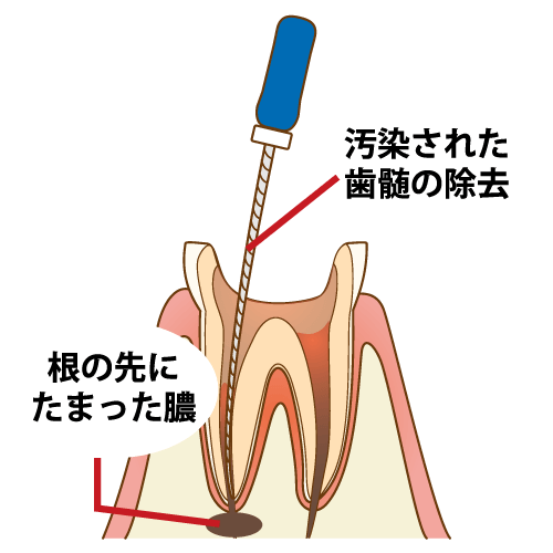 歯髄の除去