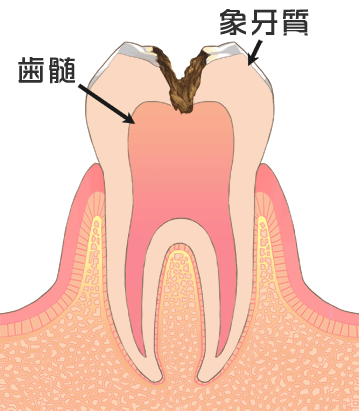 虫歯