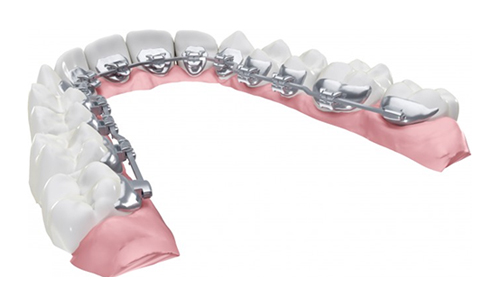 舌側矯正（リンガル矯正）