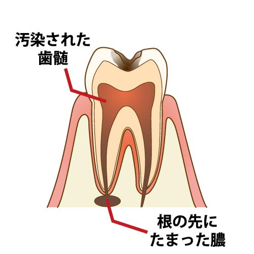 根管治療の初期症状