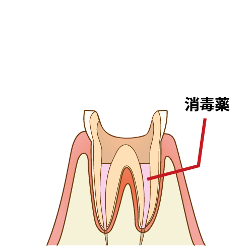 根管内の洗浄と調薬