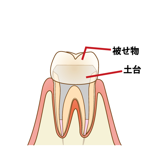 根管治療の完了